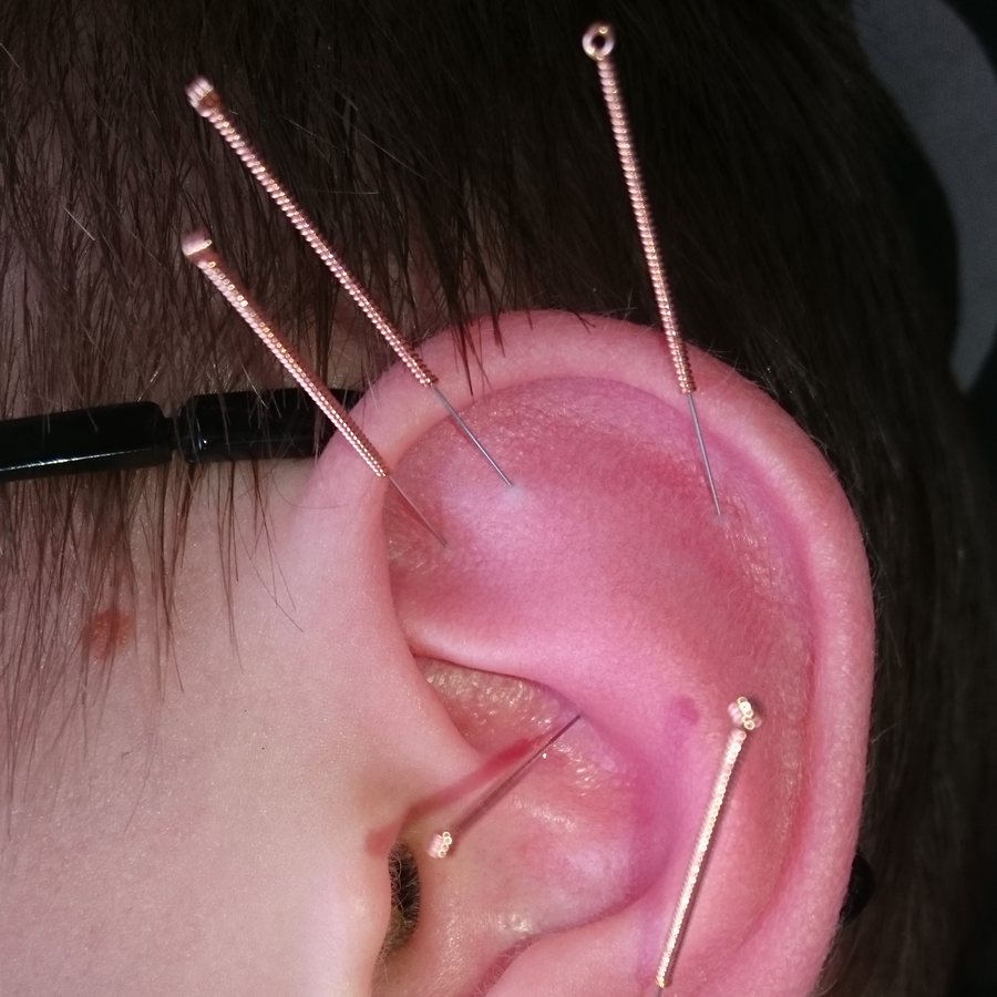 Four fine acupuncture needles inserted in the outer ear