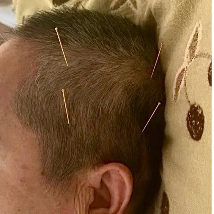 Acupuncture needles inserted along zones of a patient's scalp above the ear