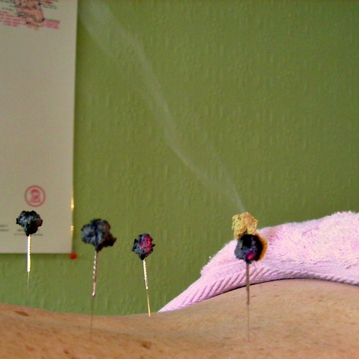 Small balls of moxa burning on the handles of acupuncture needles in a patient's back, with smoke rising