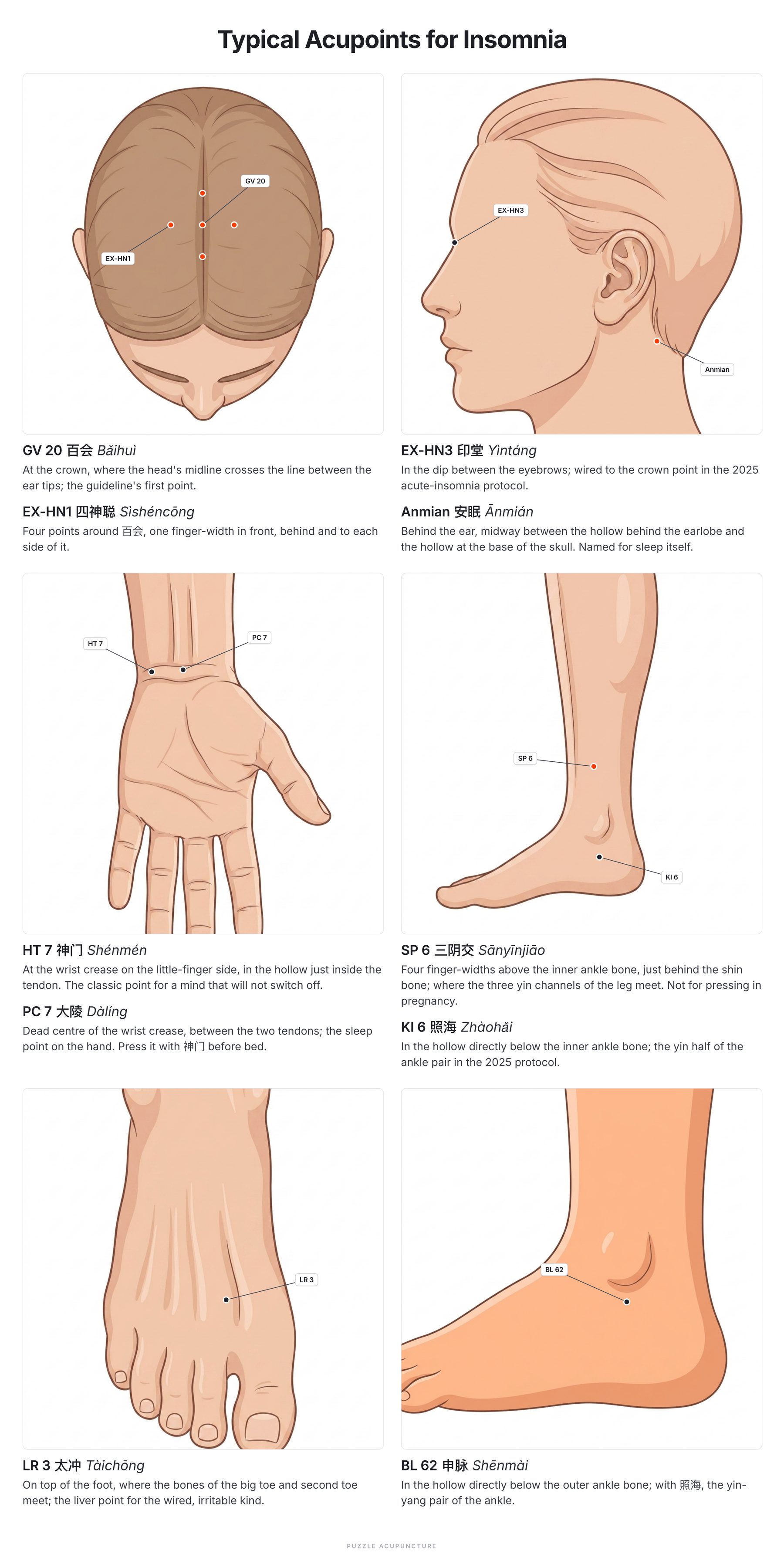 Typical acupoints for insomnia, grouped by head, hand and foot, labelled with code, Chinese name and pinyin; the four core points of the 2026 international guideline are marked