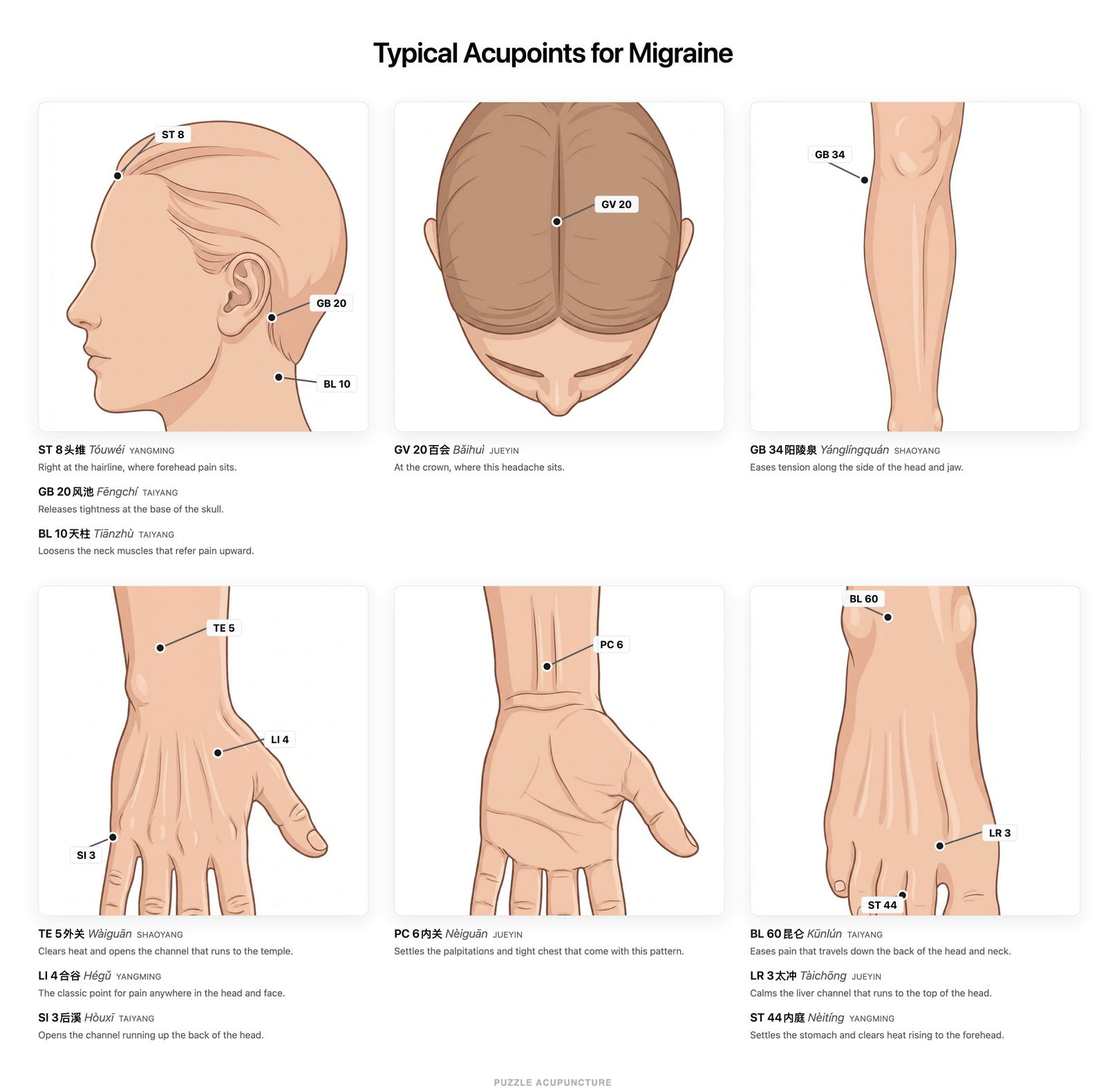 Typical acupoints for migraine, grouped by head, hand and foot, labeled with the Shaoyang, Yangming, Taiyang and Jueyin channels they belong to