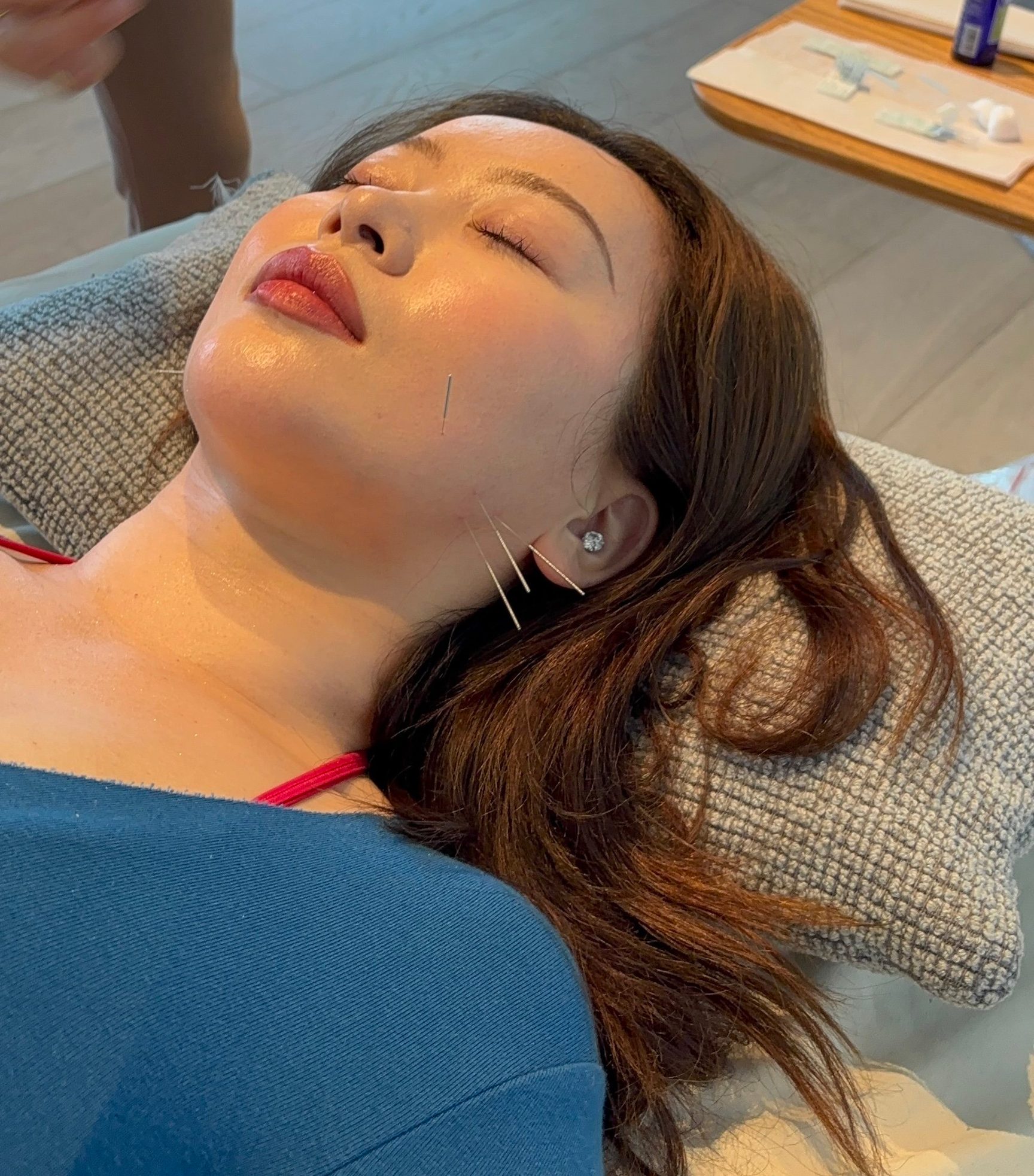 A patient rests during cheek acupuncture, with fine needles along her jaw and cheek