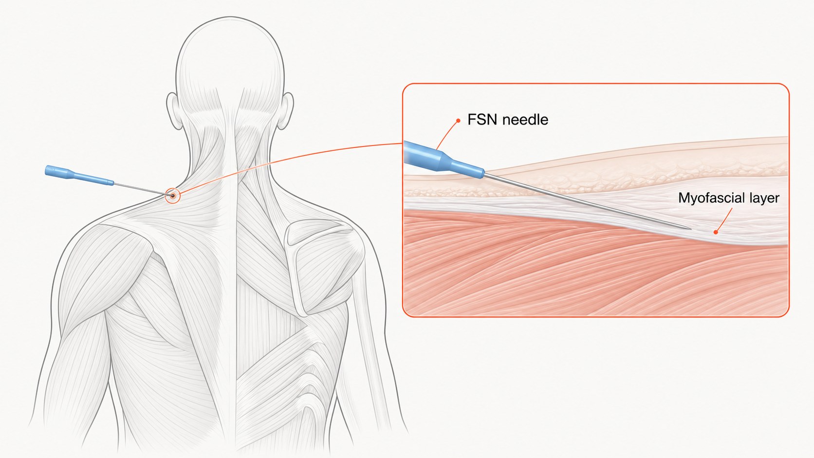 Illustration of the muscles of the upper back seen from behind, with an FSN needle entering at the top of the shoulder. An enlarged cross-section beside it shows the needle lying flat in the myofascial layer between the skin and the muscle.