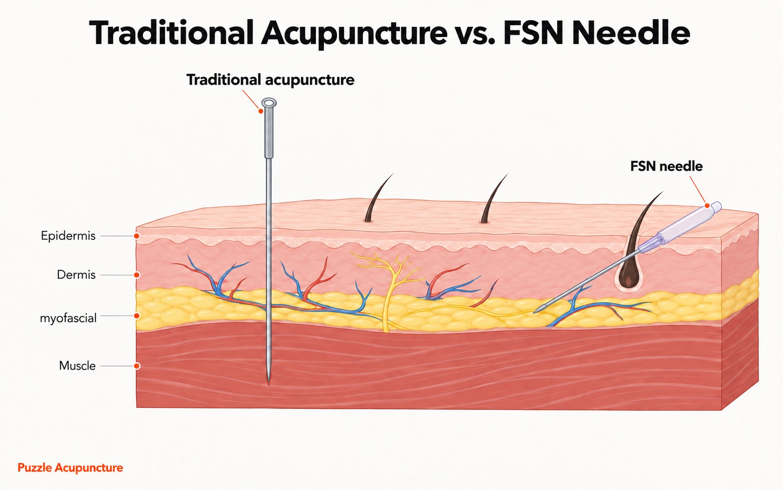 Cross-section of skin comparing two needles. A traditional acupuncture needle goes straight down through epidermis, dermis and myofascial layer into the muscle. The FSN needle enters at a shallow angle and stops in the layer above the muscle.