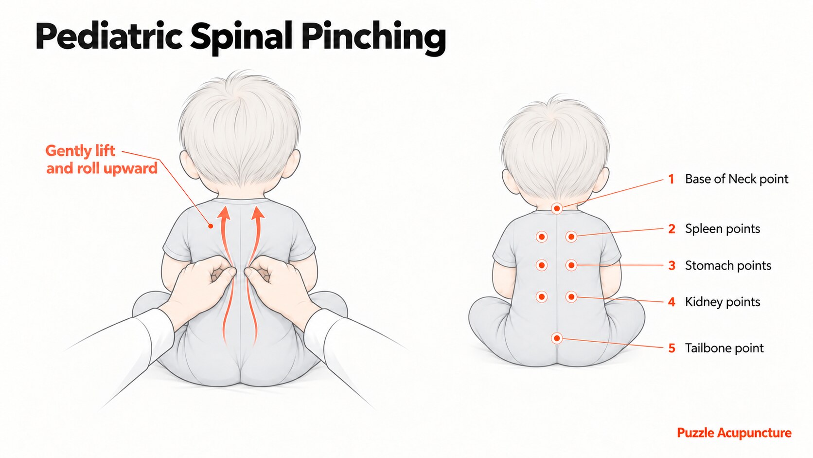 Pediatric spinal pinching, drawn twice on a child seen from behind. On the left, two hands lift the skin either side of the spine and roll it upward, with arrows running from the tailbone to the base of the neck. On the right, the five point rows the pass crosses, numbered: the base of neck point, the spleen points, the stomach points, the kidney points and the tailbone point.