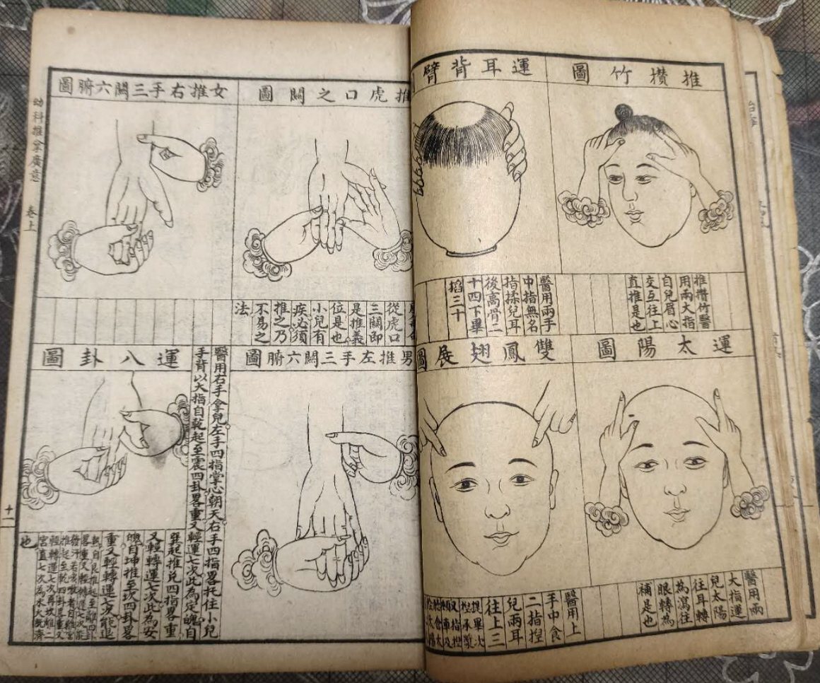 A lithographed page spread from Xiong Yingxiong's pediatric tuina manual (Youke Tuina Guangyi), volume one, page eleven: eight line drawings of a practitioner's hands on a child. On the right page, pushing up the forehead from between the brows, circling the temples, two fingers on the crown for the double-phoenix move, and a hand on the back of the head for the bone behind the ear. On the left page, pushing the Three Passes line from the web of the thumb, the left forearm for a boy and the right for a girl, and the Eight Trigrams circle on the palm. Each figure has its name in a cartouche and a column of instructions beneath.