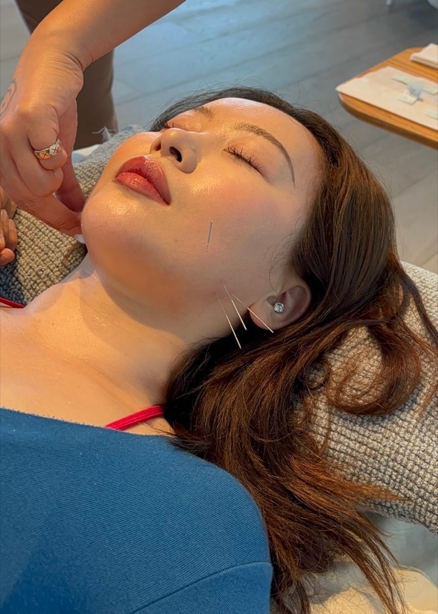 Close-up of fine acupuncture needles on a patient’s cheek and jaw