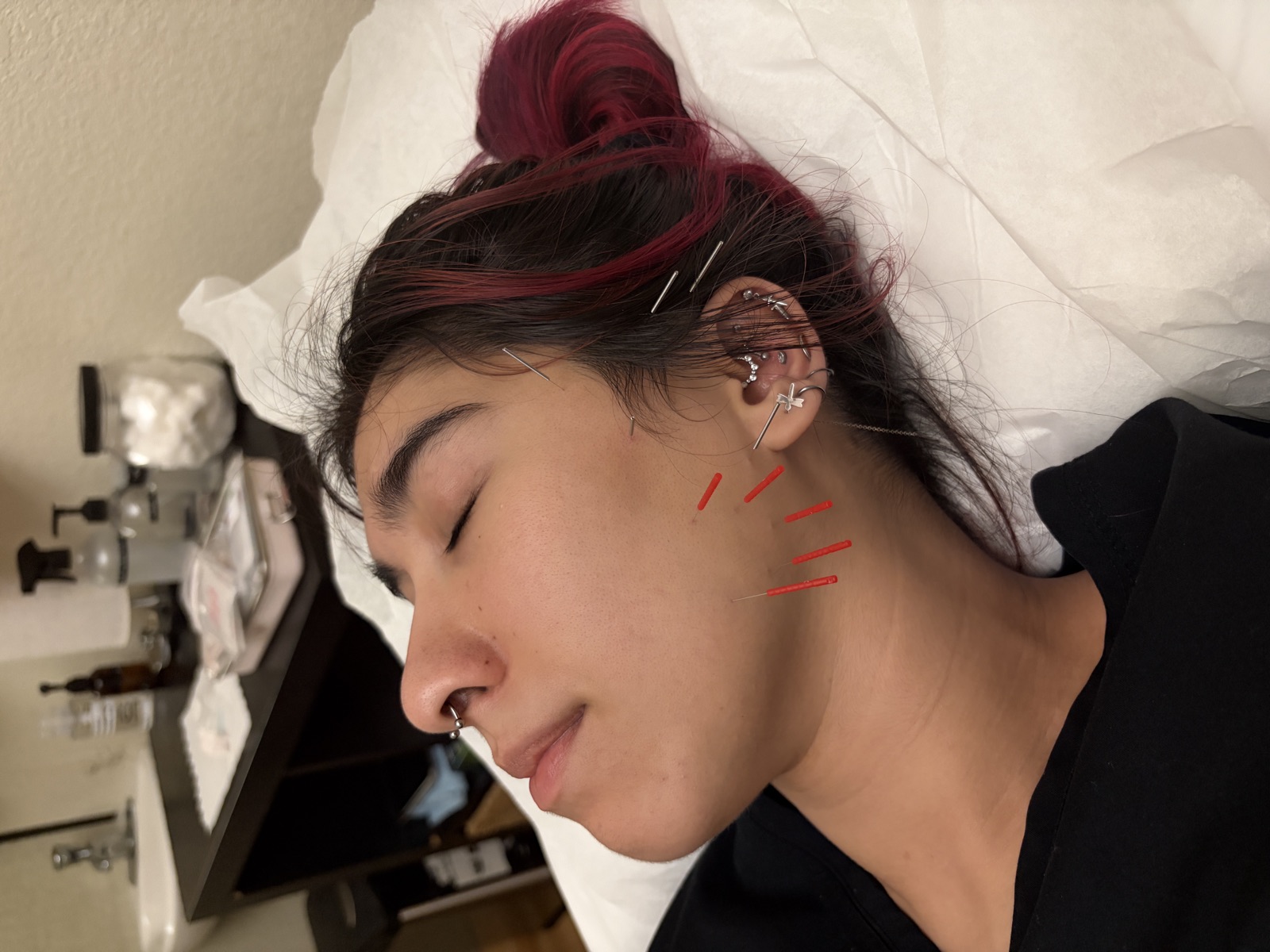 Close-up of acupuncture needles placed along a patient's jaw and temple